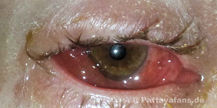 Augengrippe (Augenkrankheiten durch Adeno Viren)
