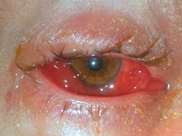 augeninfektion Thailand Urlaub